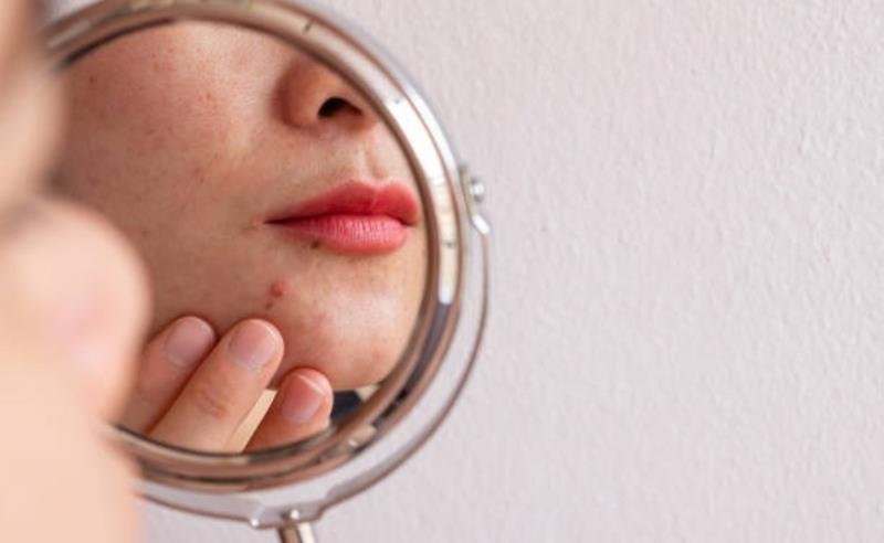 Estresse do fim do ano acende alerta para explosão de problemas de pele: dermatite, acne adulta e queda capilar disparam em dezembro